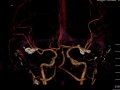 Operacja klipsowania mnogich tętniaków tętnic mózgowych